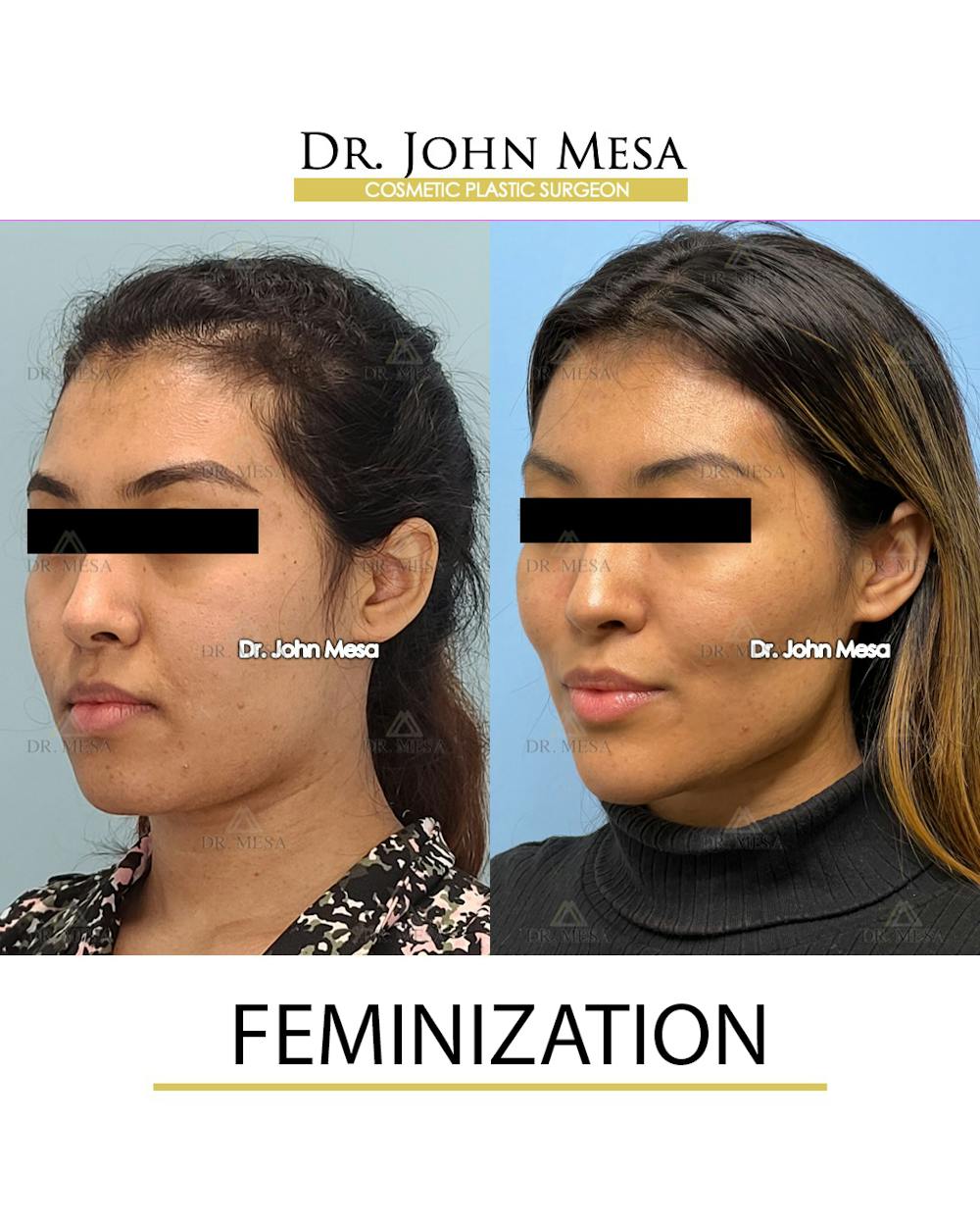 Facial Feminization Before & After Gallery - Patient 148316724 - Image 4