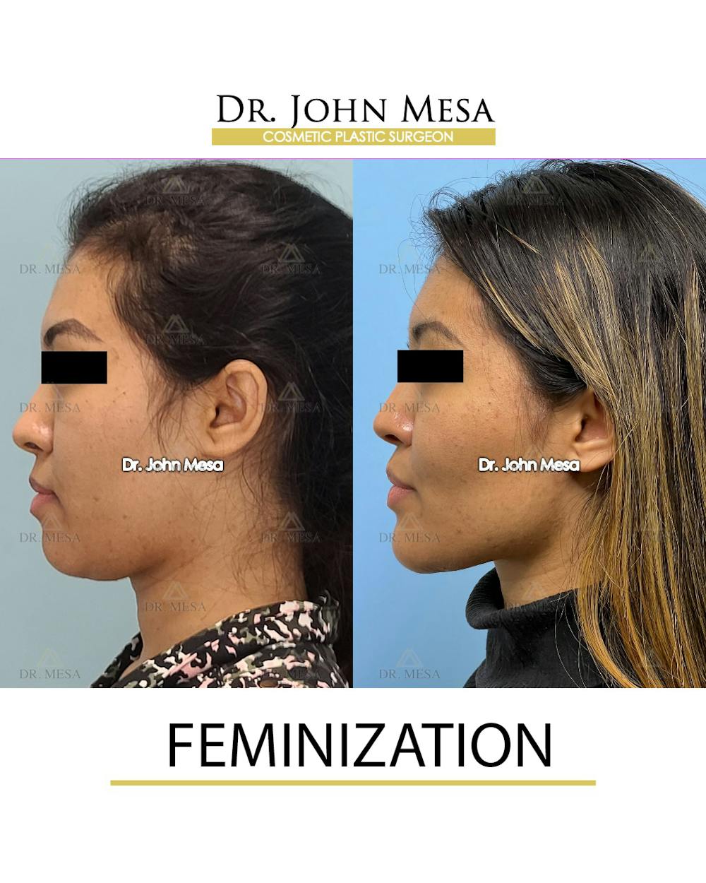 Facial Feminization Before & After Gallery - Patient 148316724 - Image 5
