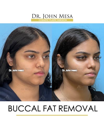 Buccal Fat Pad Removal Before & After Gallery - Patient 148733440 - Image 2