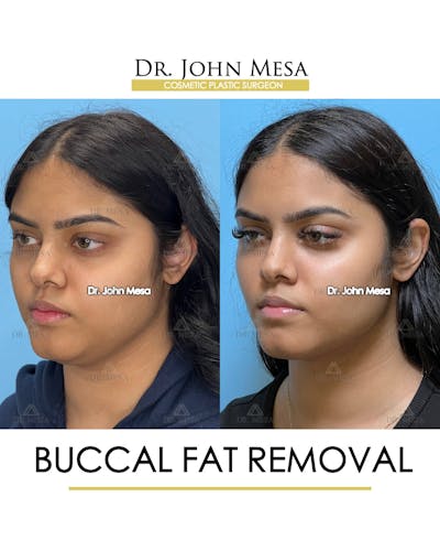 Buccal Fat Pad Removal Before & After Gallery - Patient 148733440 - Image 4