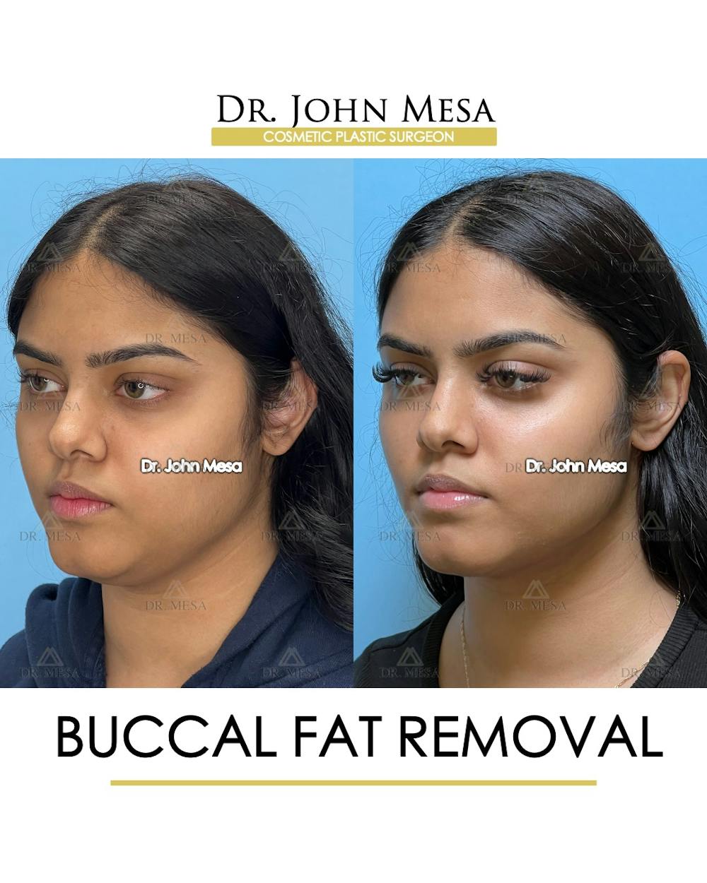 Buccal Fat Pad Removal Before & After Gallery - Patient 148733440 - Image 4