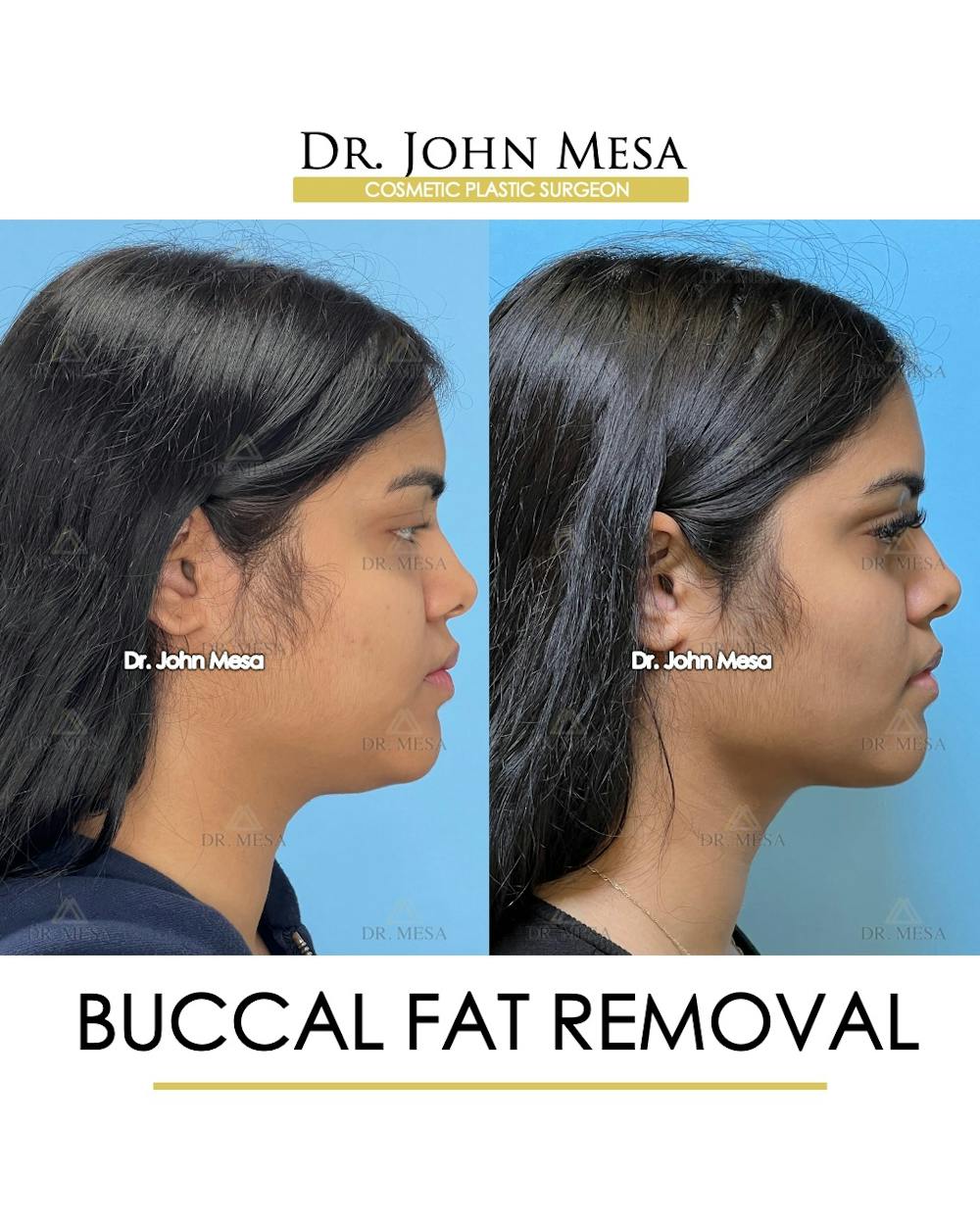 Buccal Fat Pad Removal Before & After Gallery - Patient 148733440 - Image 3