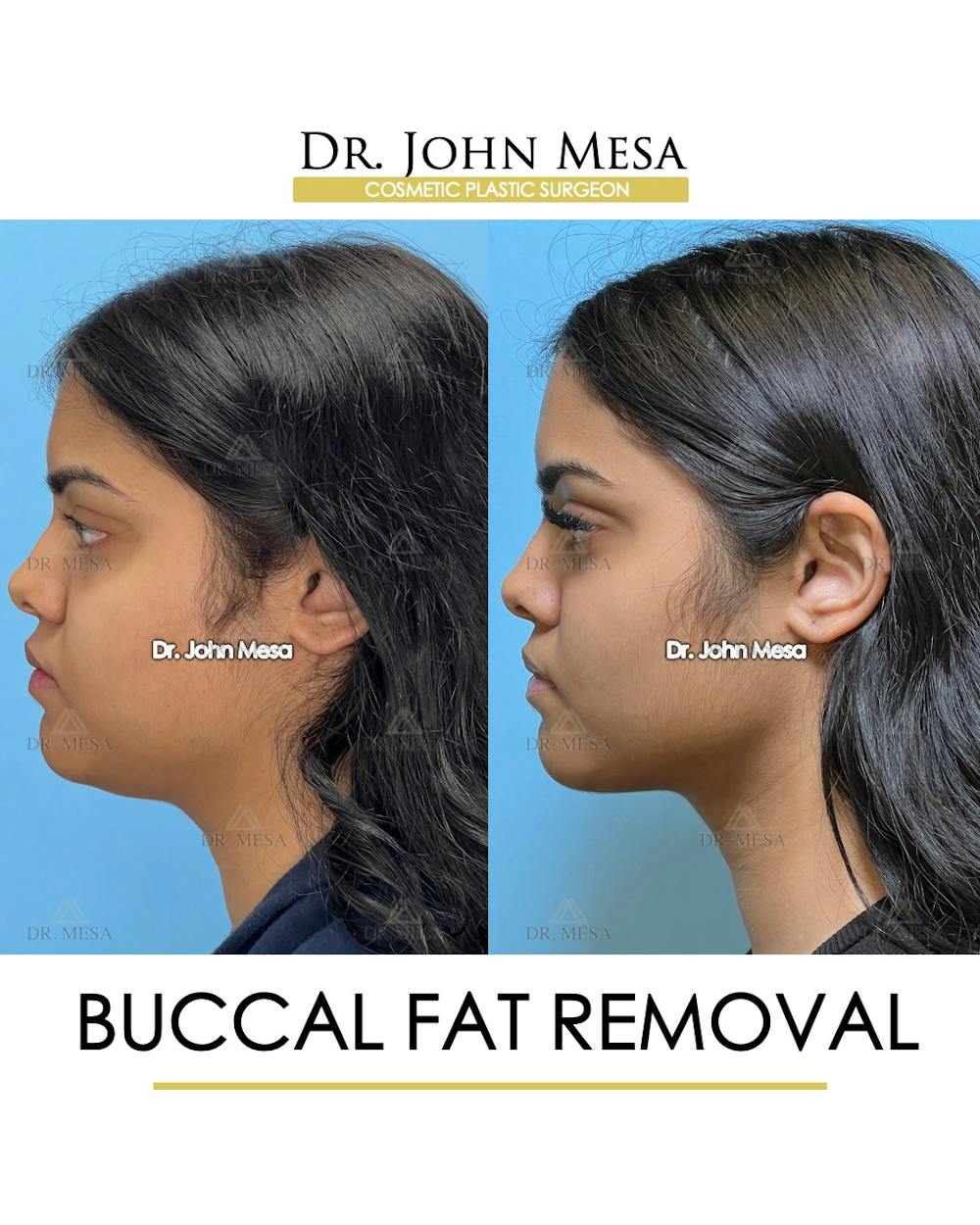 Buccal Fat Pad Removal Before & After Gallery - Patient 148733440 - Image 5