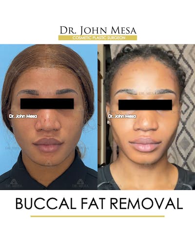 Buccal Fat Pad Removal Before & After Gallery - Patient 148733439 - Image 1