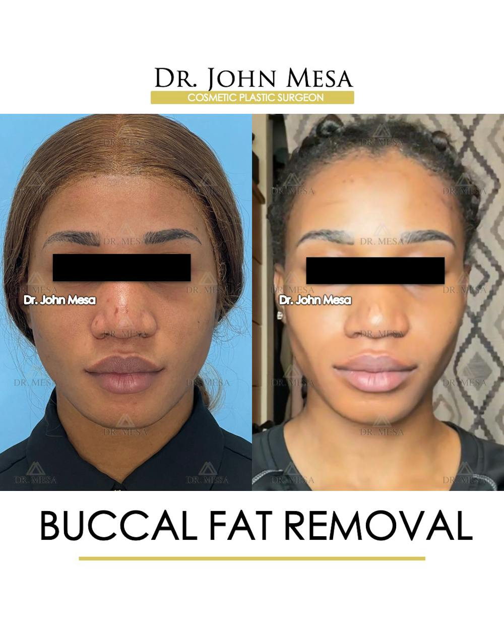 Buccal Fat Pad Removal Before & After Gallery - Patient 148733439 - Image 1