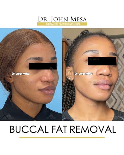 Buccal Fat Pad Removal Before & After Gallery - Patient 148733439 - Image 2