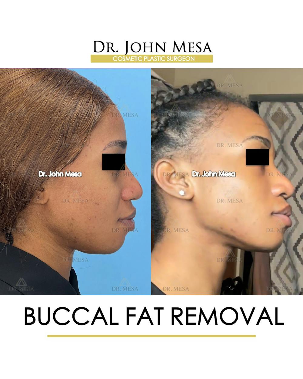Buccal Fat Pad Removal Before & After Gallery - Patient 148733439 - Image 3