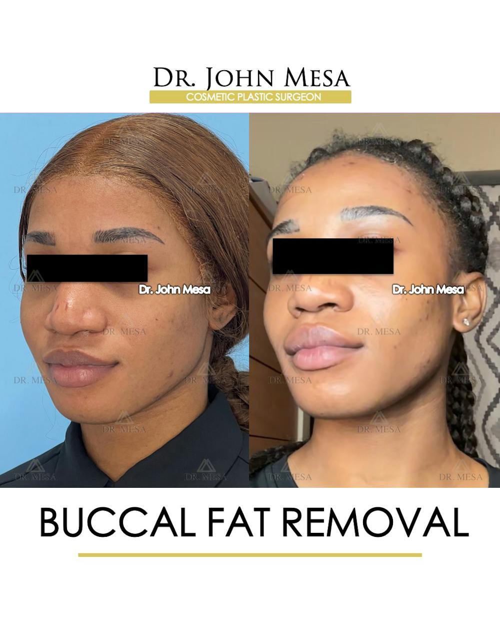 Buccal Fat Pad Removal Before & After Gallery - Patient 148733439 - Image 4