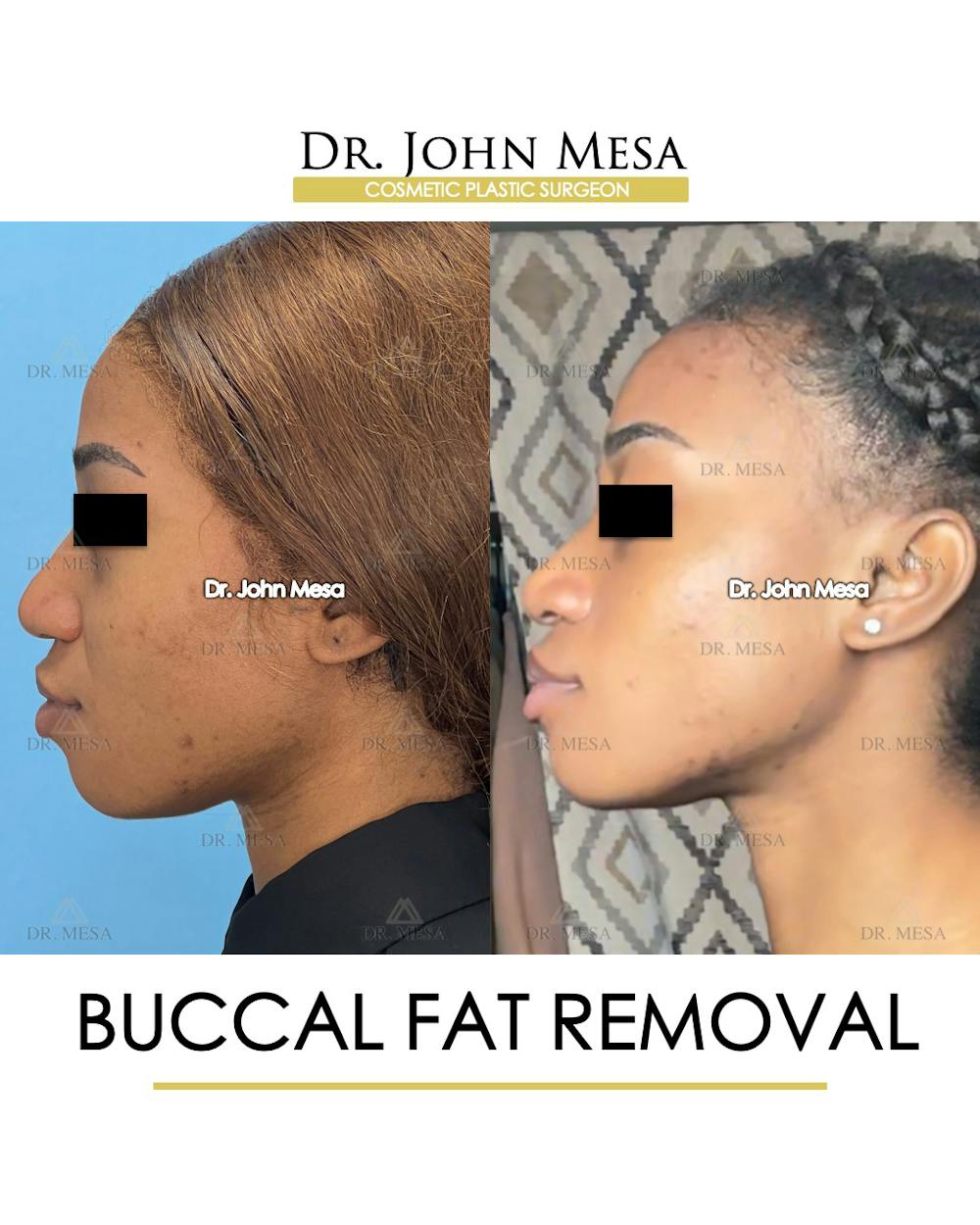 Buccal Fat Pad Removal Before & After Gallery - Patient 148733439 - Image 5