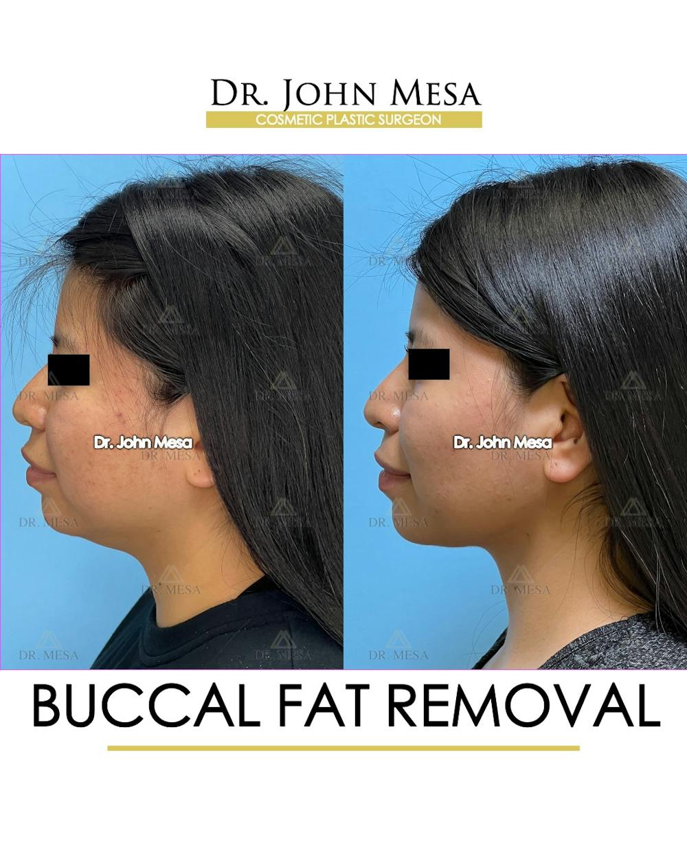 Buccal Fat Pad Removal Before & After Gallery - Patient 148733438 - Image 5