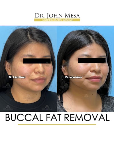 Patient 26207656, Buccal Fat Pad Removal Before & After Photos