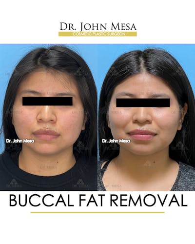 Buccal Fat Pad Removal Before & After Gallery - Patient 148733438 - Image 1