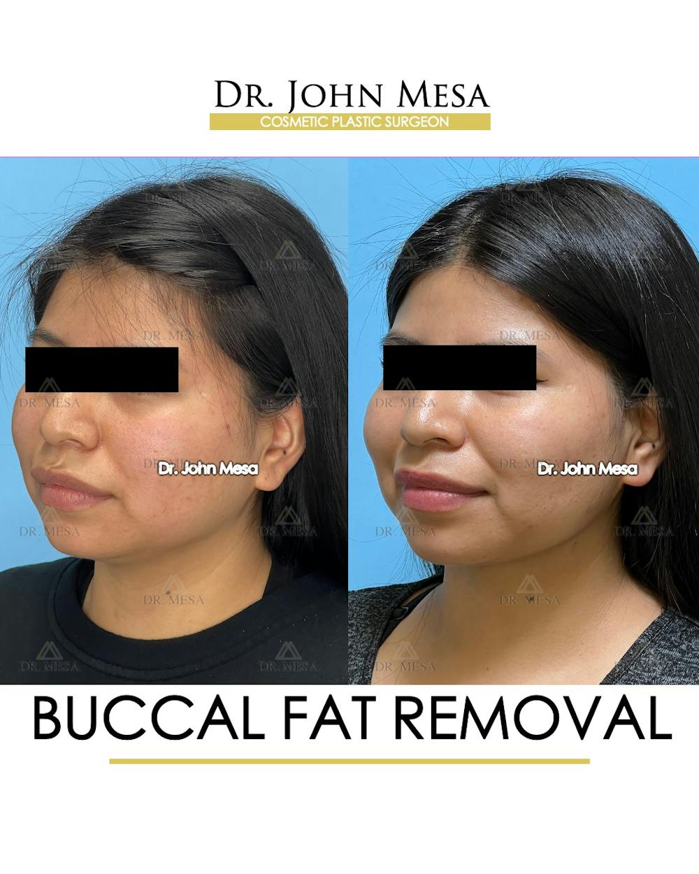 Buccal Fat Pad Removal Before & After Gallery - Patient 148733438 - Image 4