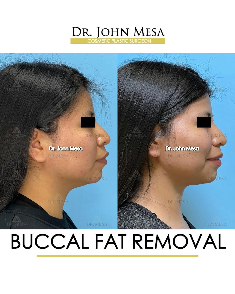 Buccal Fat Pad Removal Before & After Gallery - Patient 148733438 - Image 3