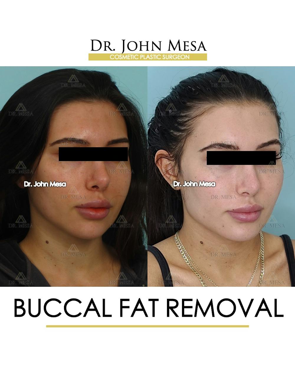 Buccal Fat Pad Removal Before & After Gallery - Patient 148733437 - Image 2