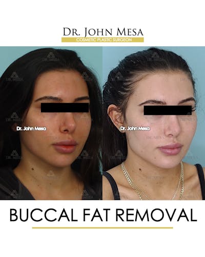 Buccal Fat Pad Removal Before & After Gallery - Patient 148733437 - Image 2