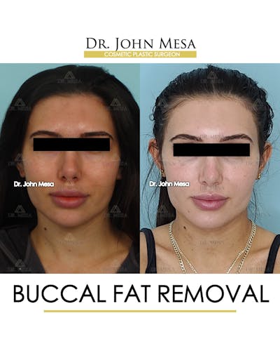 Buccal Fat Pad Removal Before & After Gallery - Patient 148733437 - Image 1