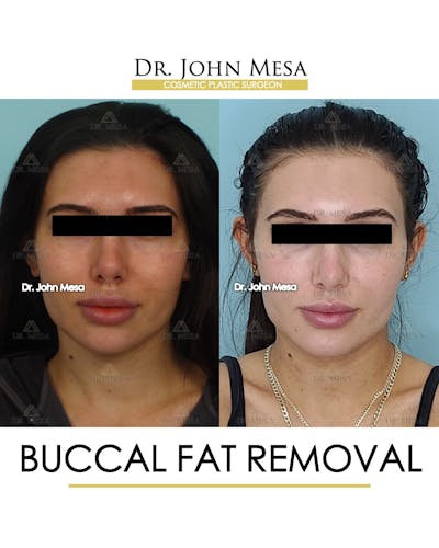 Buccal Fat Pad Removal Before & After Gallery - Patient 148733437 - Image 1