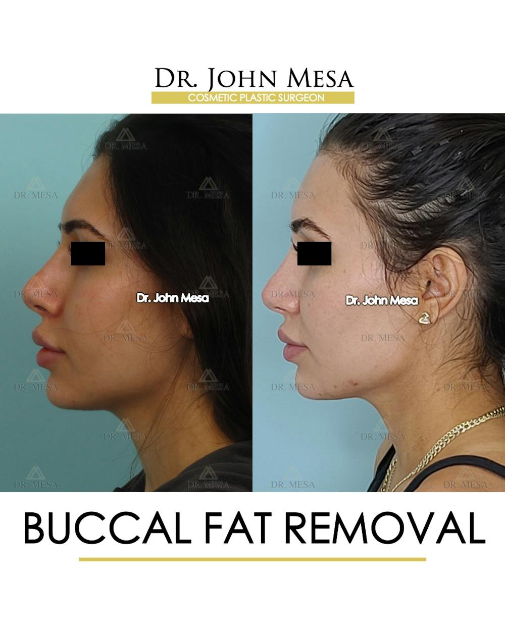 Buccal Fat Pad Removal Before & After Gallery - Patient 148733437 - Image 5