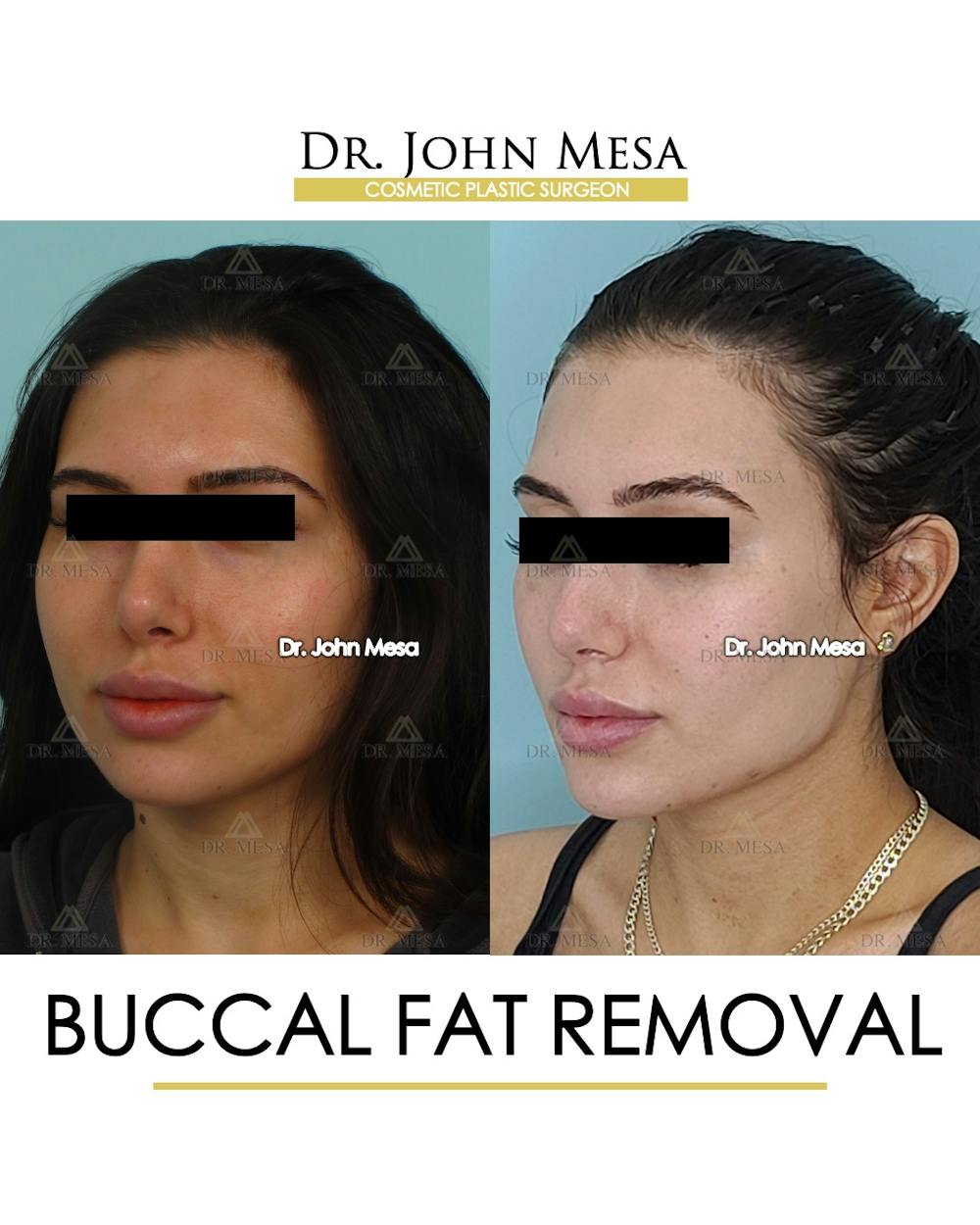 Buccal Fat Pad Removal Before & After Gallery - Patient 148733437 - Image 4