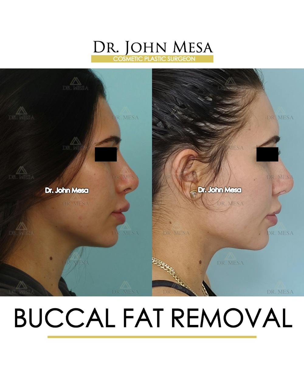 Buccal Fat Pad Removal Before & After Gallery - Patient 148733437 - Image 3