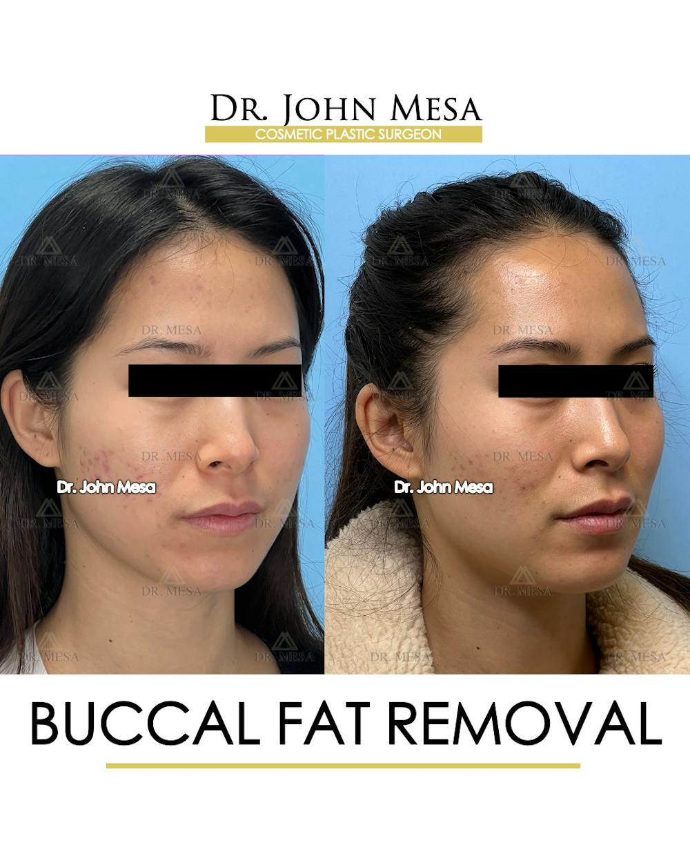 Buccal Fat Pad Removal Before & After Gallery - Patient 148733436 - Image 2