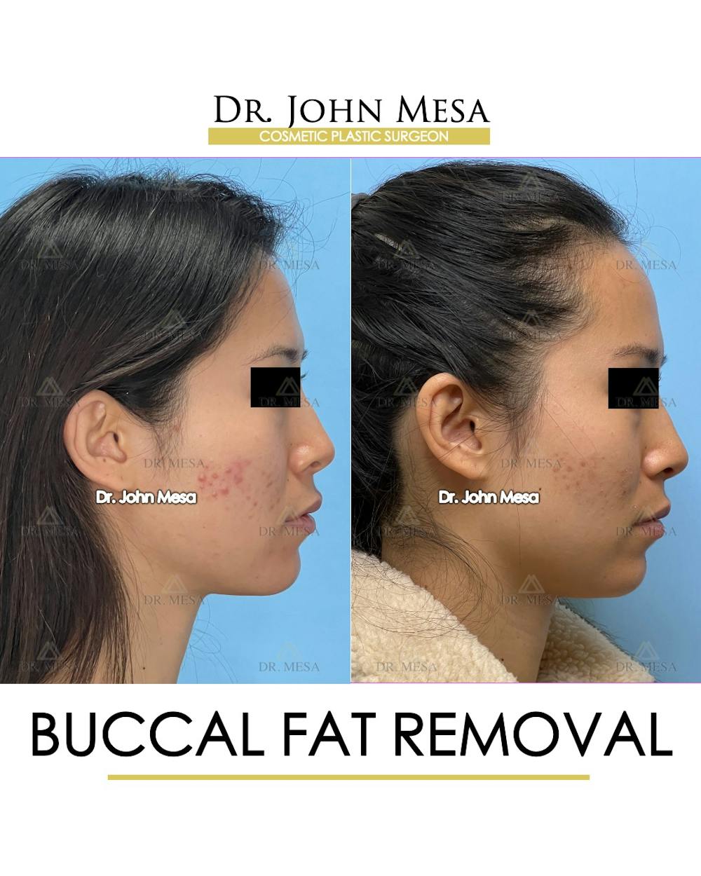 Buccal Fat Pad Removal Before & After Gallery - Patient 148733436 - Image 3