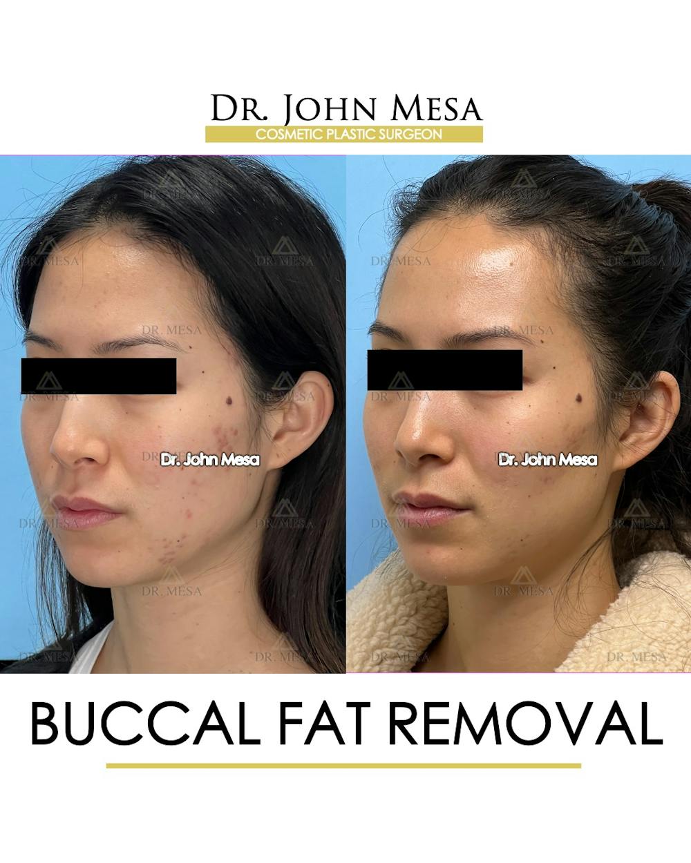 Buccal Fat Pad Removal Before & After Gallery - Patient 148733436 - Image 4