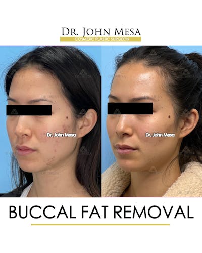 Buccal Fat Pad Removal Before & After Gallery - Patient 148733436 - Image 4