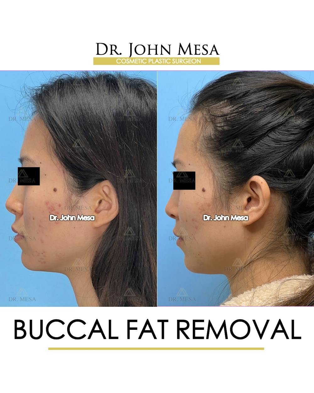 Buccal Fat Pad Removal Before & After Gallery - Patient 148733436 - Image 5