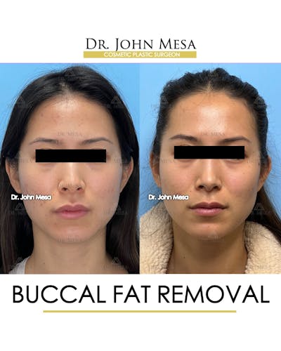 Buccal Fat Pad Removal Before & After Gallery - Patient 148733436 - Image 1