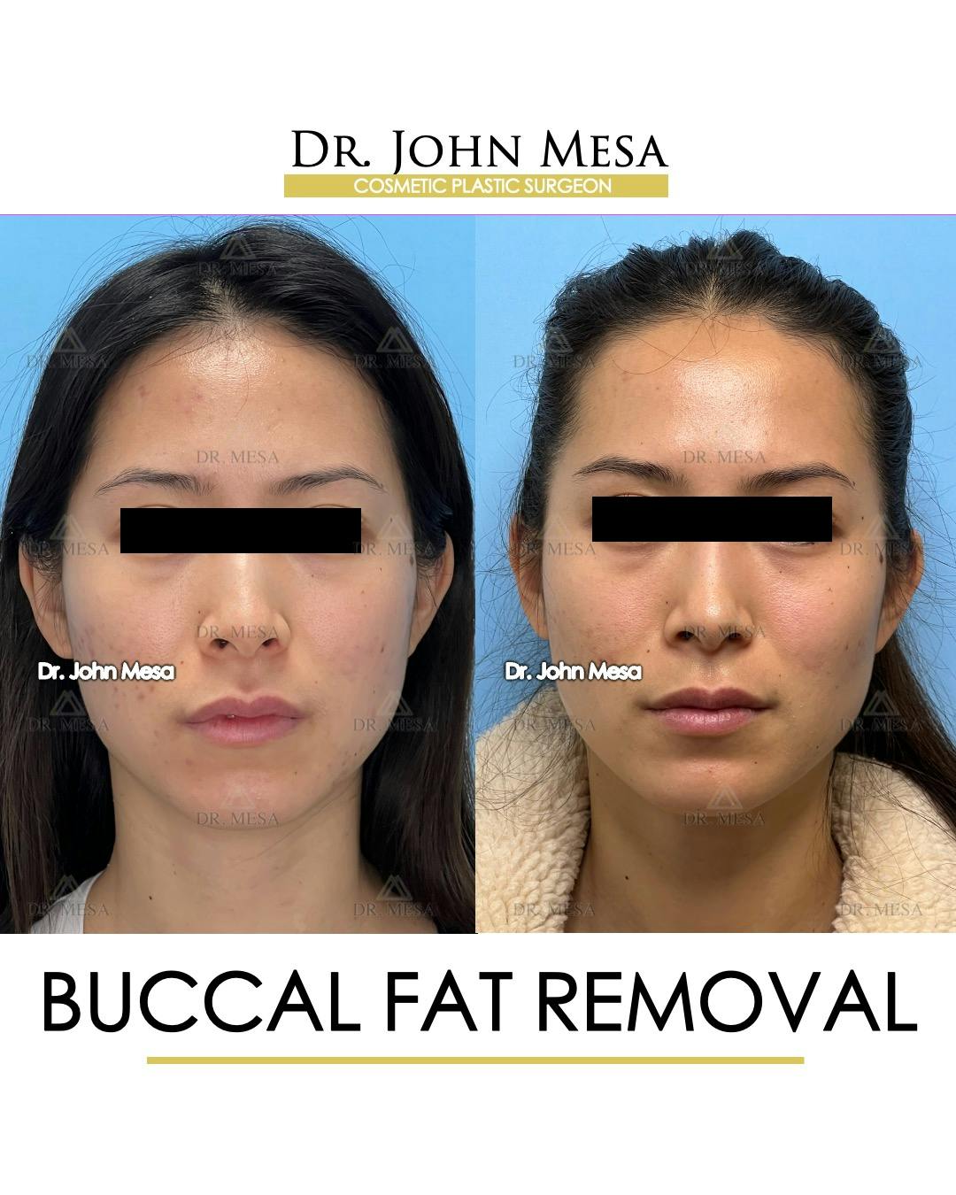 Buccal Fat Pad Removal Before & After Gallery - Patient 148733436 - Image 1