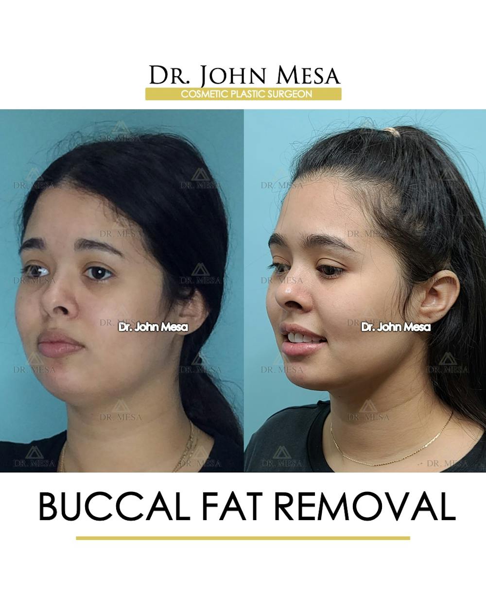 Buccal Fat Pad Removal Before & After Gallery - Patient 148733446 - Image 4