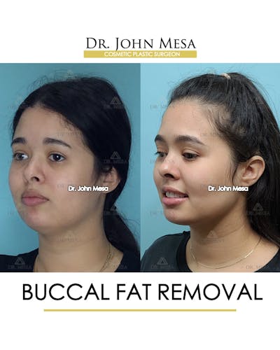 Patient 26207656, Buccal Fat Pad Removal Before & After Photos