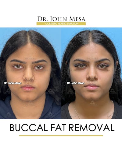 Buccal Fat Pad Removal Before & After Gallery - Patient 148733440 - Image 1