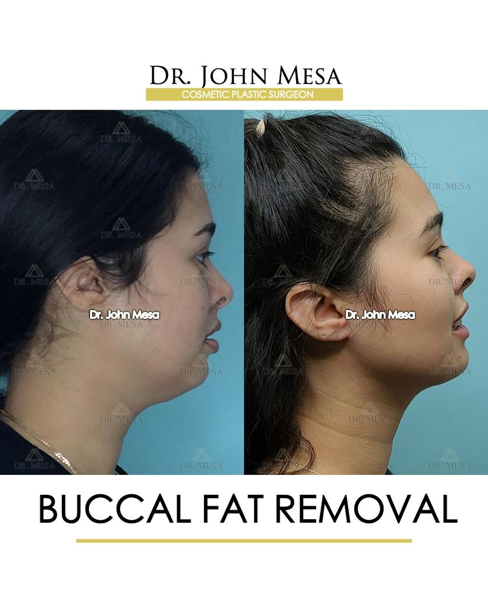 Buccal Fat Pad Removal Before & After Gallery - Patient 148733446 - Image 3