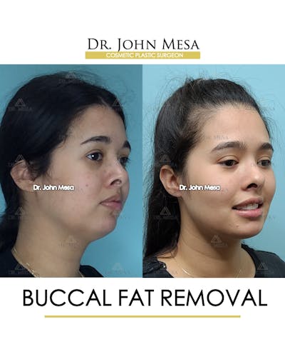 Buccal Fat Pad Removal Before & After Gallery - Patient 148733446 - Image 2