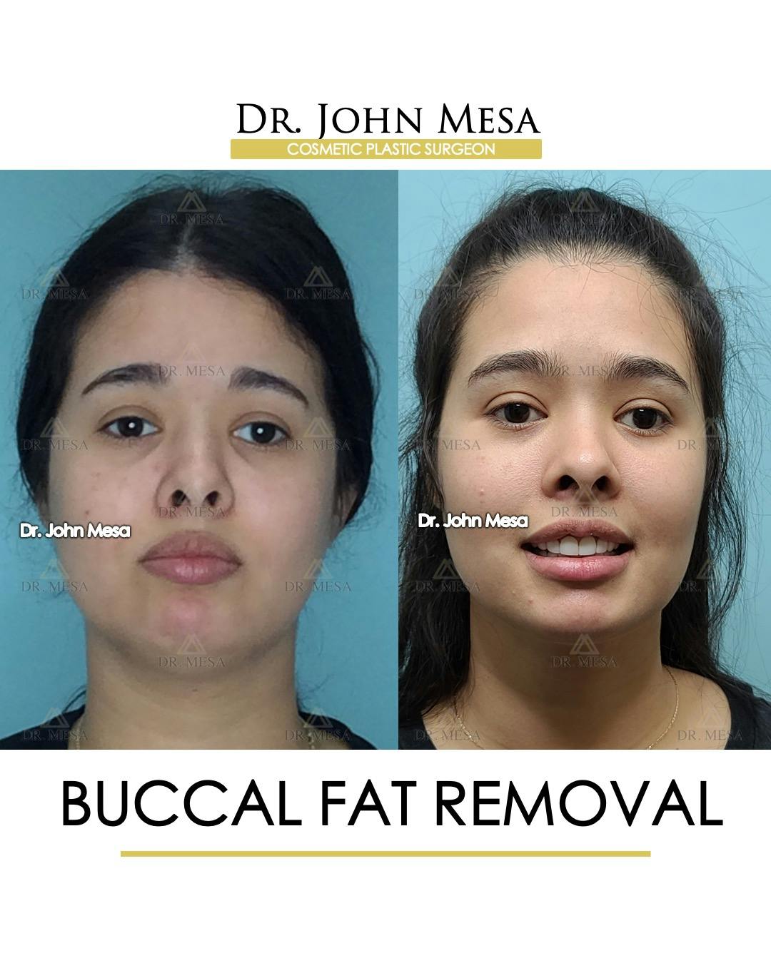 Buccal Fat Pad Removal Before & After Gallery - Patient 148733446 - Image 1