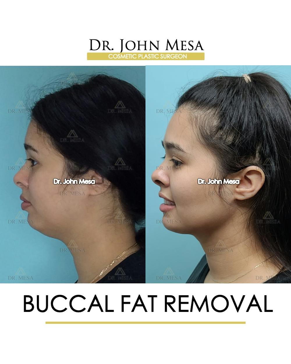Buccal Fat Pad Removal Before & After Gallery - Patient 148733446 - Image 5