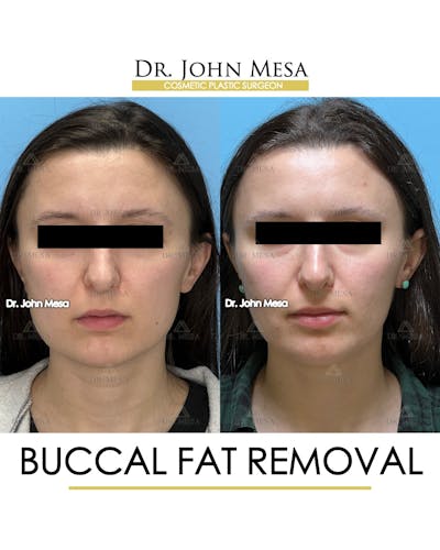 Buccal Fat Pad Removal Before & After Gallery - Patient 148733445 - Image 1