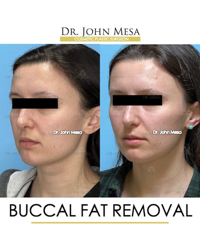 Buccal Fat Pad Removal Before & After Gallery - Patient 148733445 - Image 4