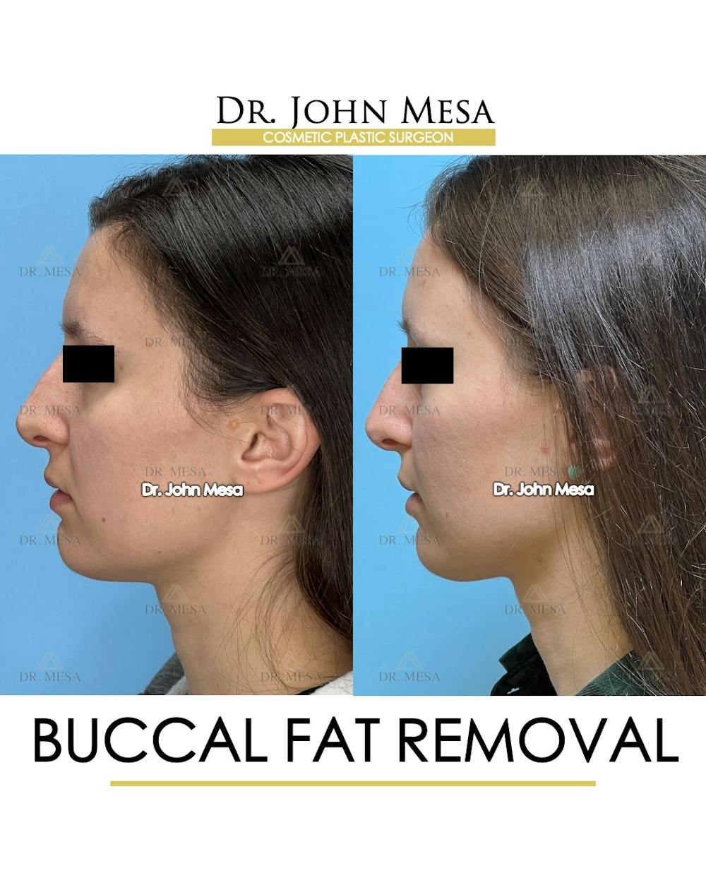 Buccal Fat Pad Removal Before & After Gallery - Patient 148733445 - Image 5