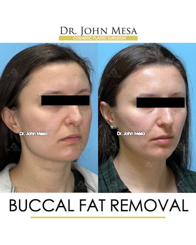 Buccal Fat Pad Removal Before & After Gallery - Patient 148733445 - Image 2
