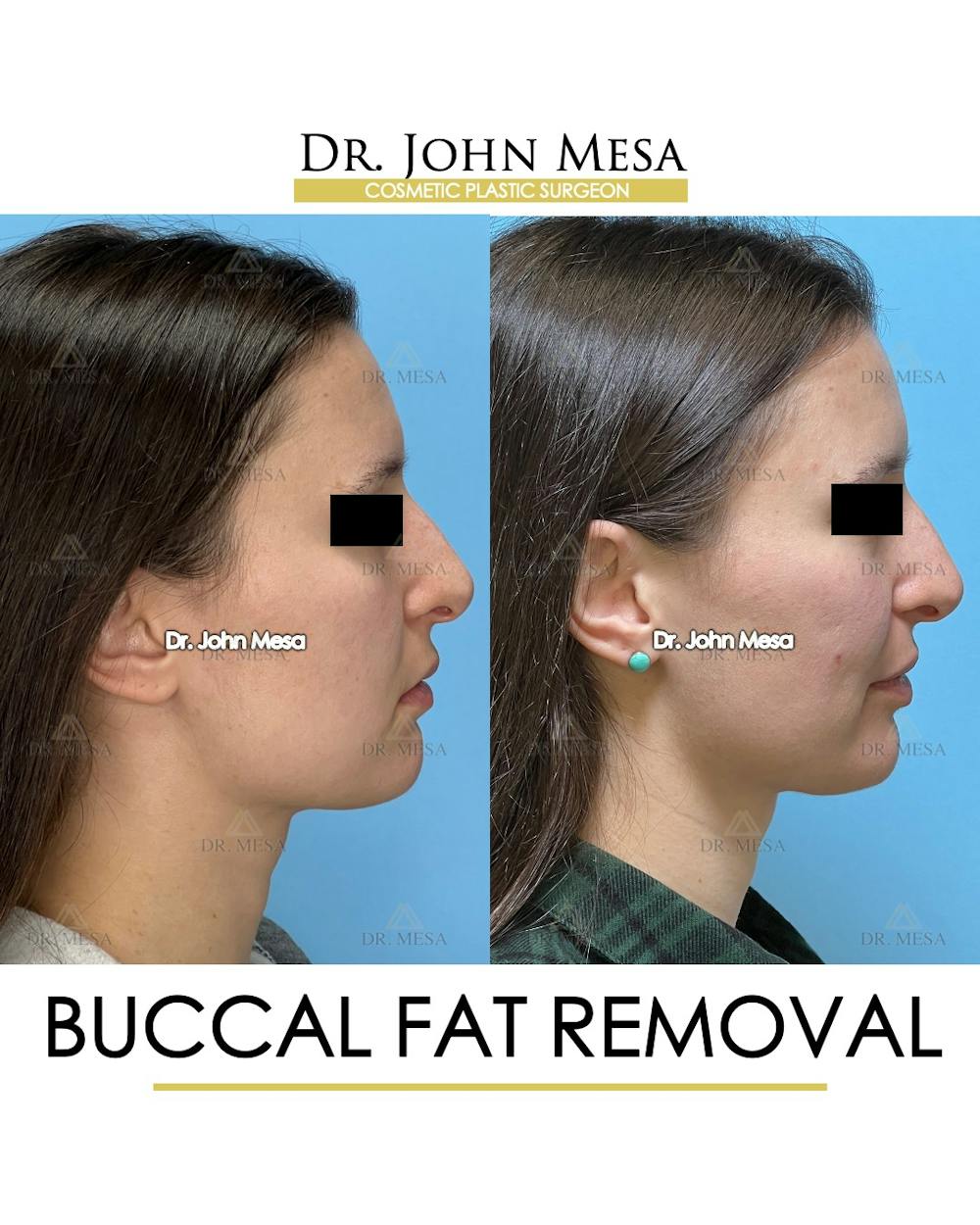Buccal Fat Pad Removal Before & After Gallery - Patient 148733445 - Image 3