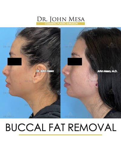 Buccal Fat Pad Removal Before & After Gallery - Patient 148733444 - Image 6