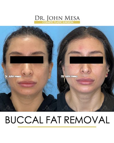 Buccal Fat Pad Removal Before & After Gallery - Patient 148733444 - Image 1