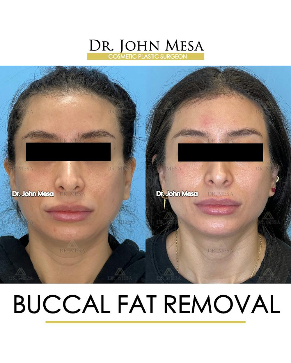 Buccal Fat Pad Removal Before & After Gallery - Patient 148733444 - Image 1