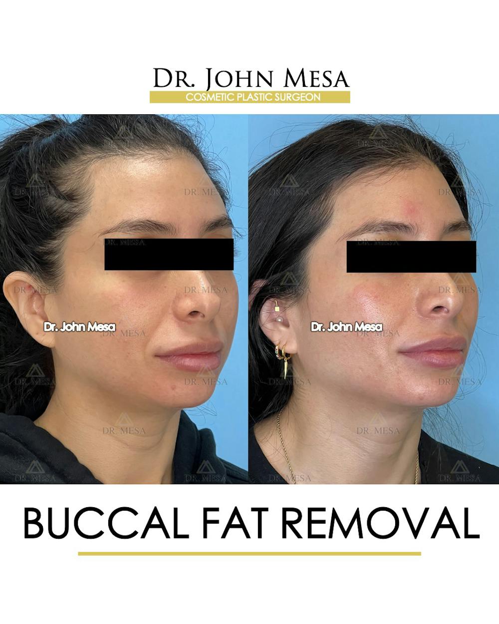 Buccal Fat Pad Removal Before & After Gallery - Patient 148733444 - Image 3