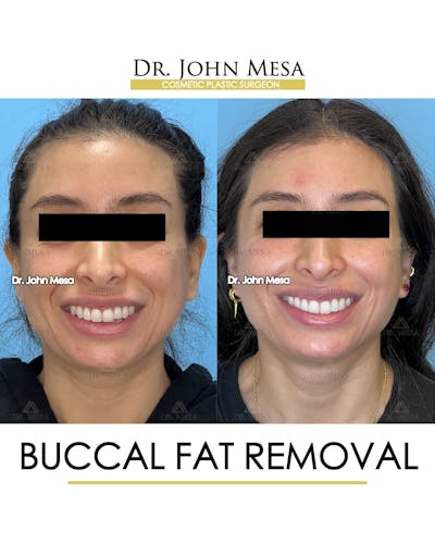 Buccal Fat Pad Removal Before & After Gallery - Patient 148733444 - Image 2