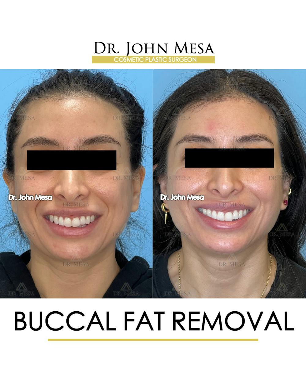 Buccal Fat Pad Removal Before & After Gallery - Patient 148733444 - Image 2